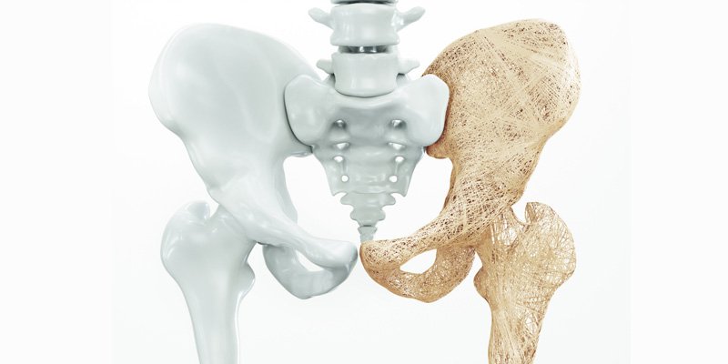 Osteoporose Knochenerkrankung im hohen Alter