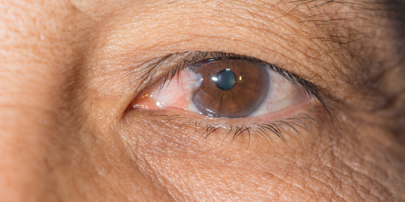 Pterygium