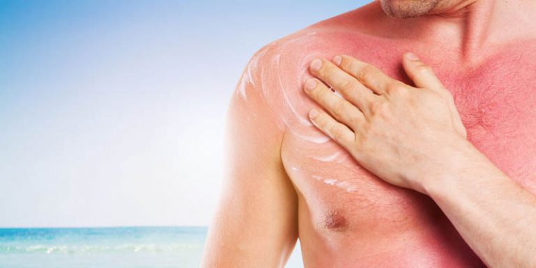Darf Man Die Haut Nach Einem Sonnenbrand Abziehen Sonnenbrand - Dermatitis Solaris nach dem Sonnenbaden
