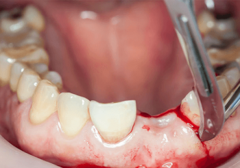 Oralchirurgie