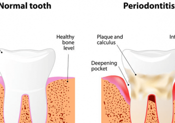 Periodontitis