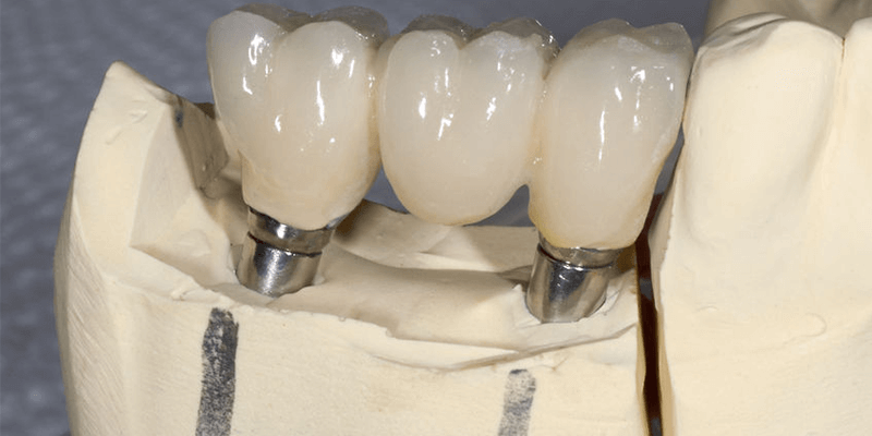 Risiken mit Implantaten