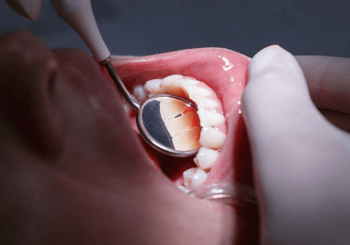 Zahnfleischerkrankungen