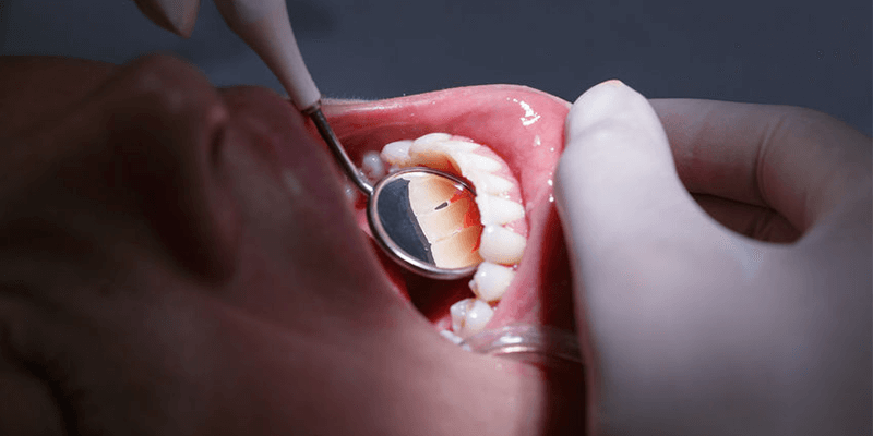 Zahnfleischerkrankungen