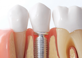 Zahnimplantate