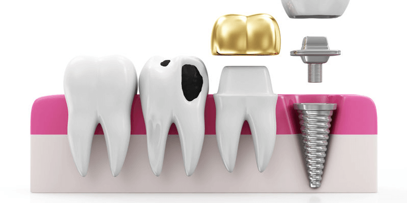 Gegenanzeigen für eine Implantatsbehandlung